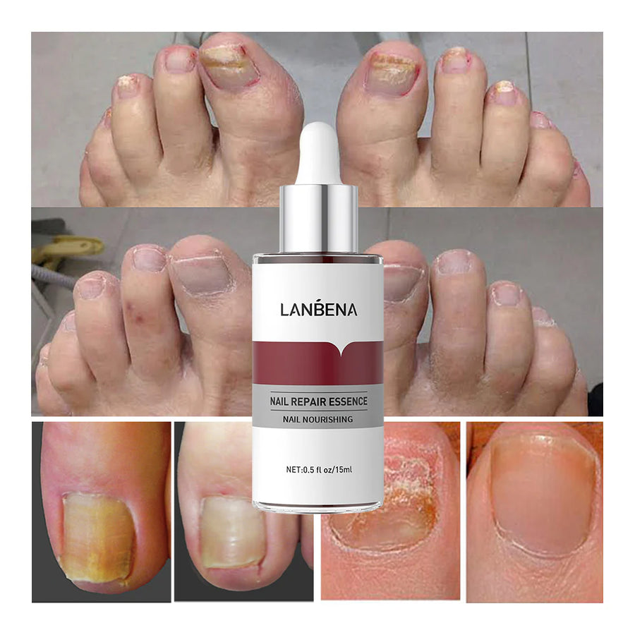 Nail Repair Serum For Fungus