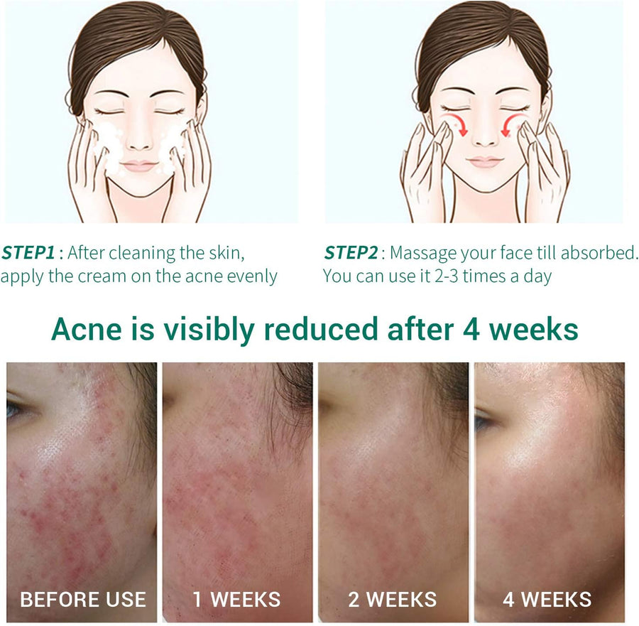 Lanbena Acne Treatment Gel