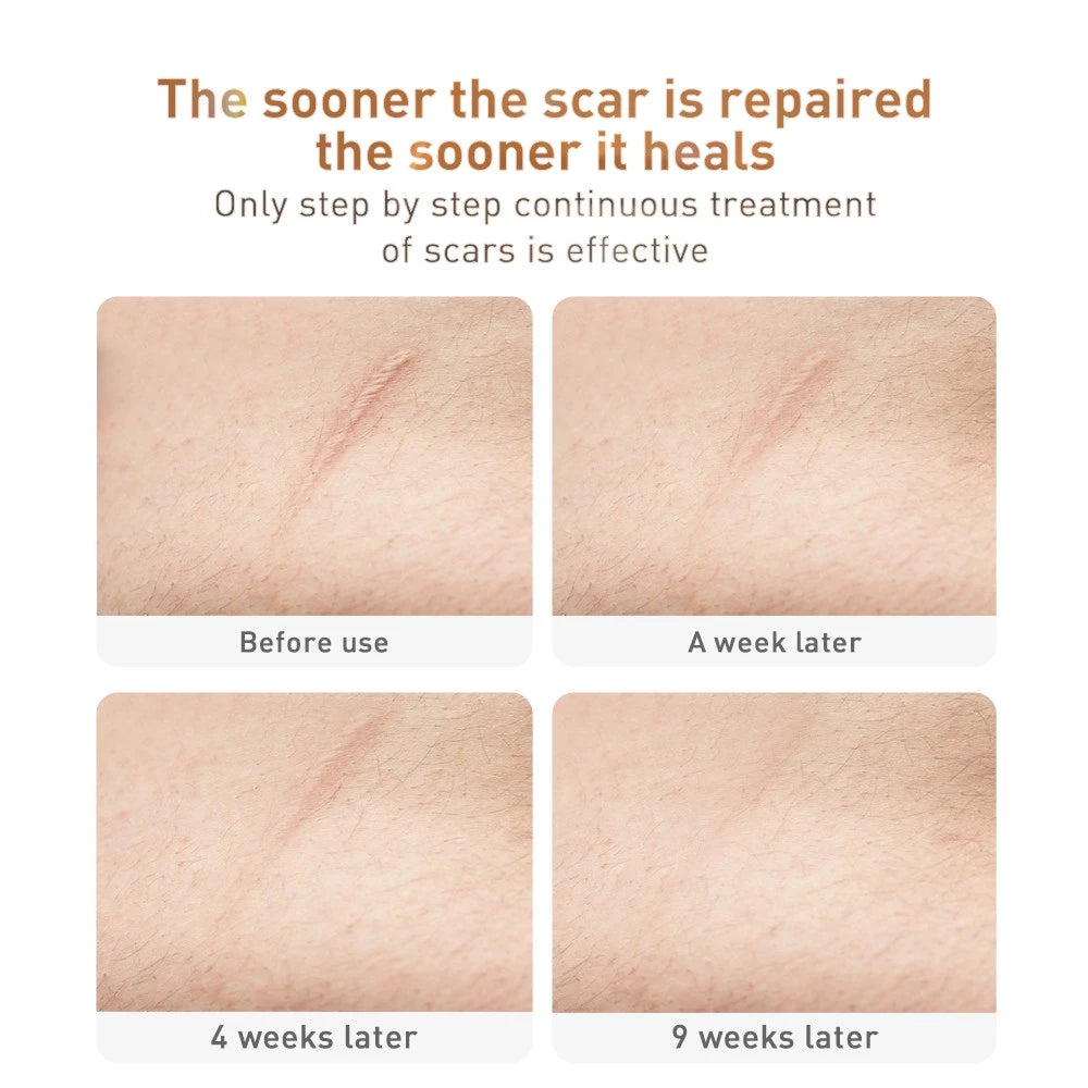 Scar Removal Gel