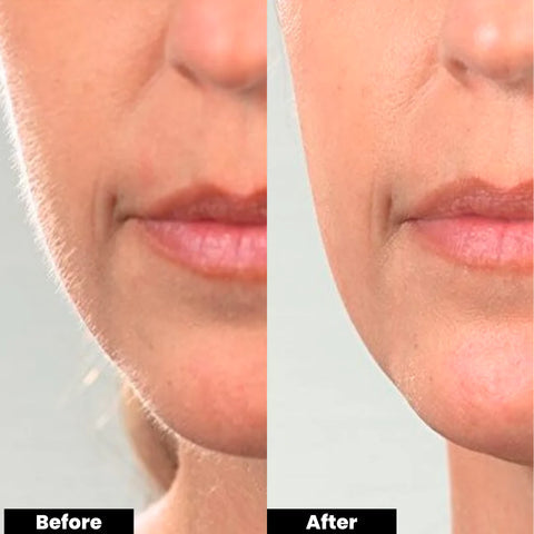 Facial Hair Removal