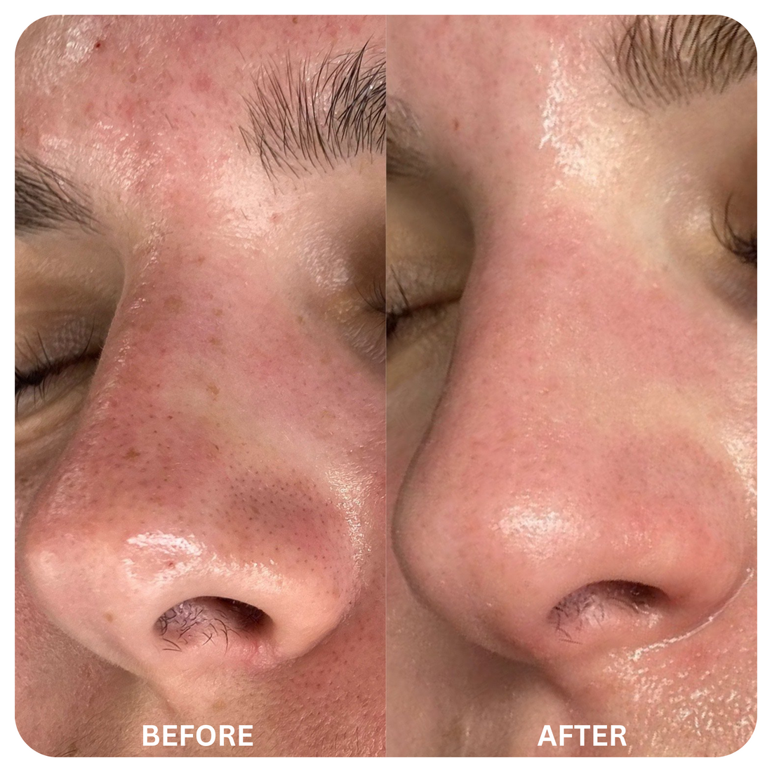 Blackhead Remover Mask 2.0