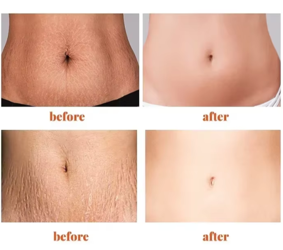Stretch Marks Cream