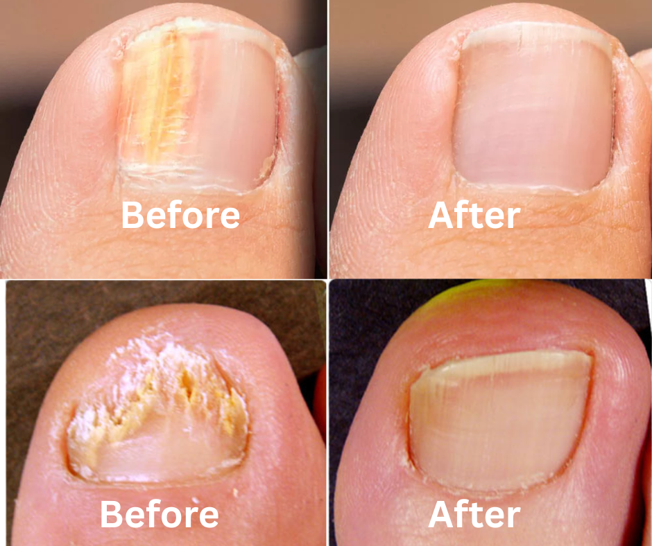Nail Repair Serum For Fungus