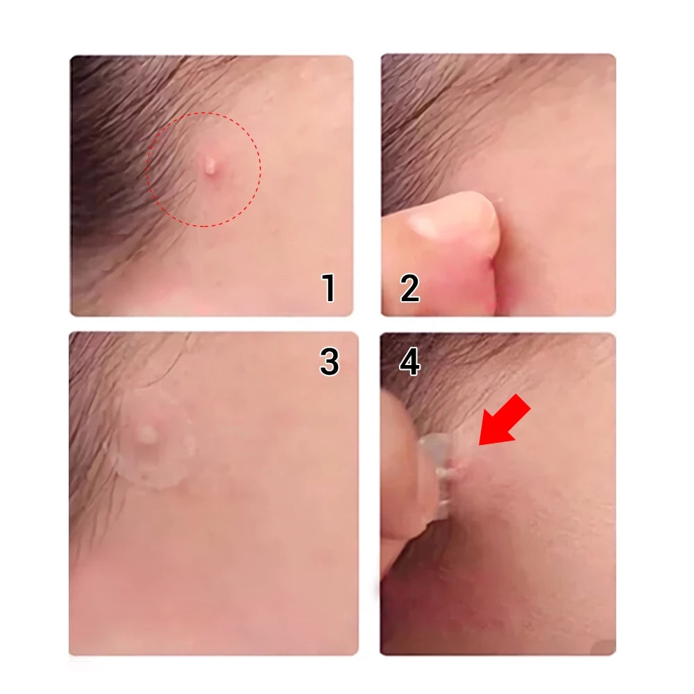 Acne Pimple Patches