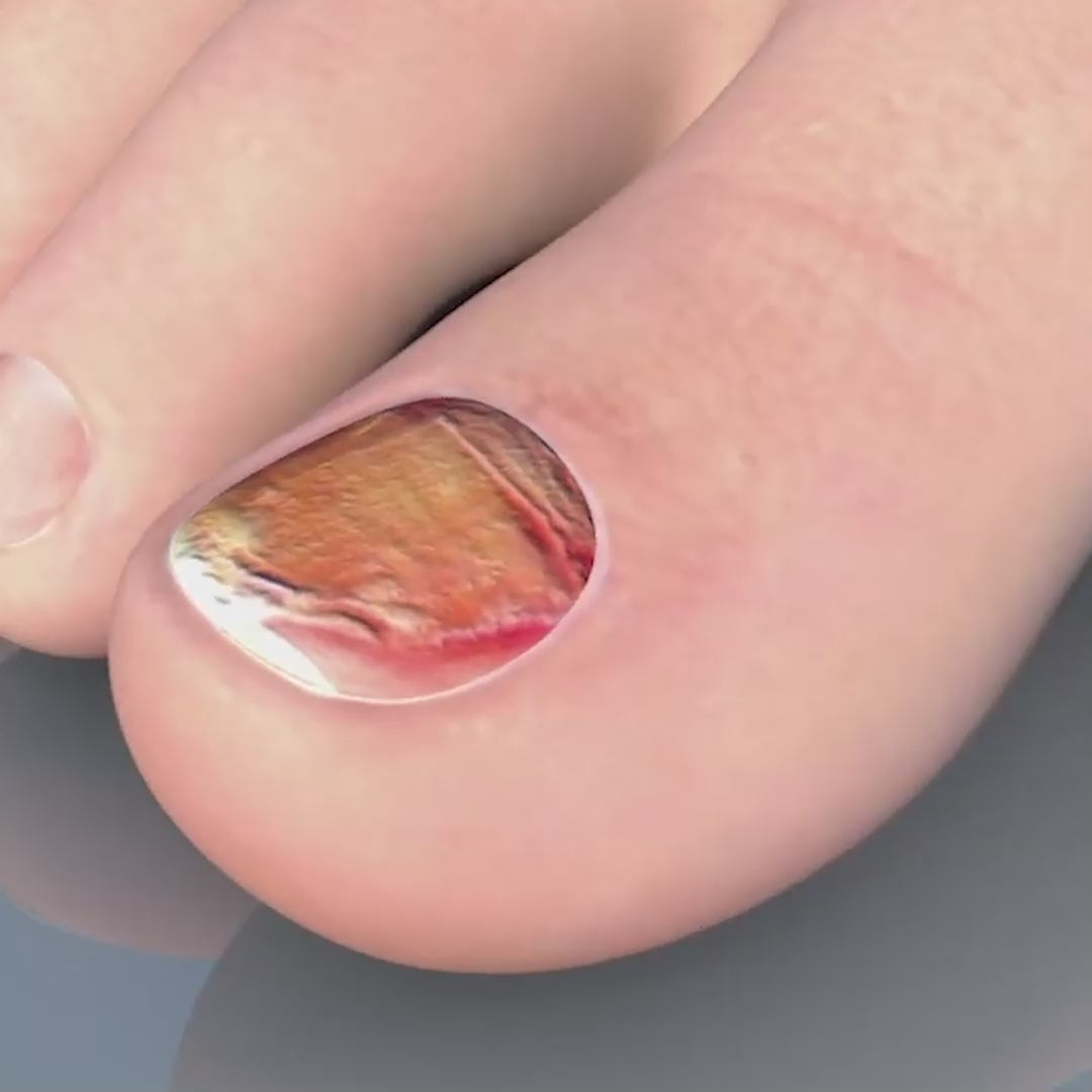 Nail Repair Serum For Fungus